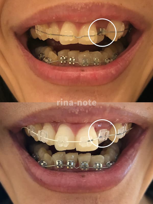 歯列矯正器具交換