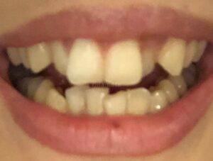 歯列矯正前の歯