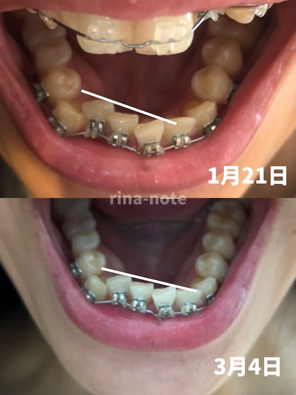 歯列矯正経過4