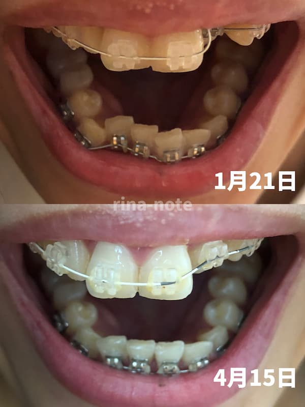 歯列矯正経過7