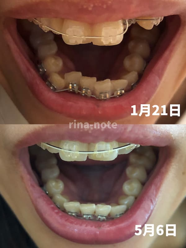 歯列矯正経過正面上
