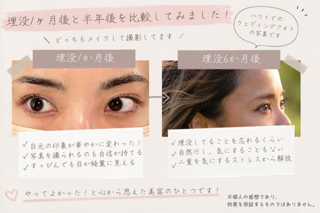 埋没1か月後と半年後の比較写真