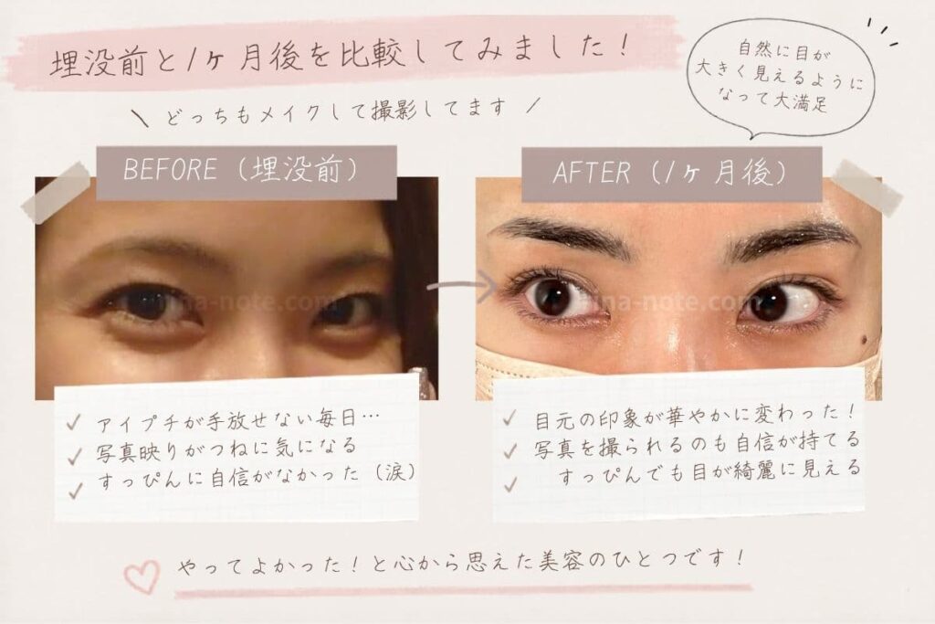 埋没前と1か月後の目元比較写真