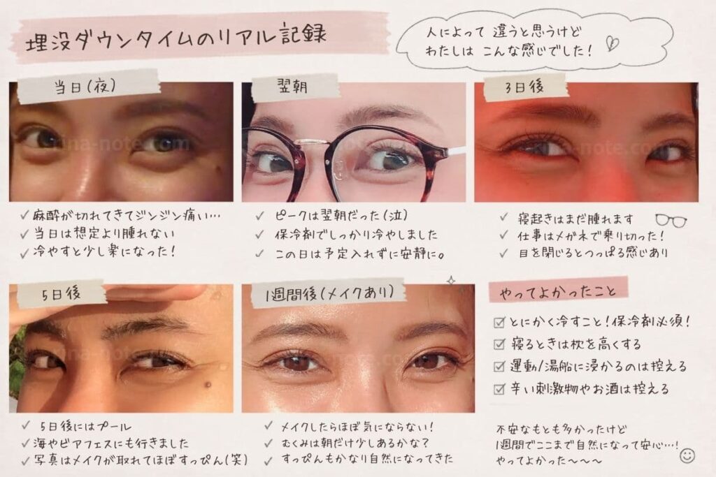 埋没ダウンタイムのリアル経過記録