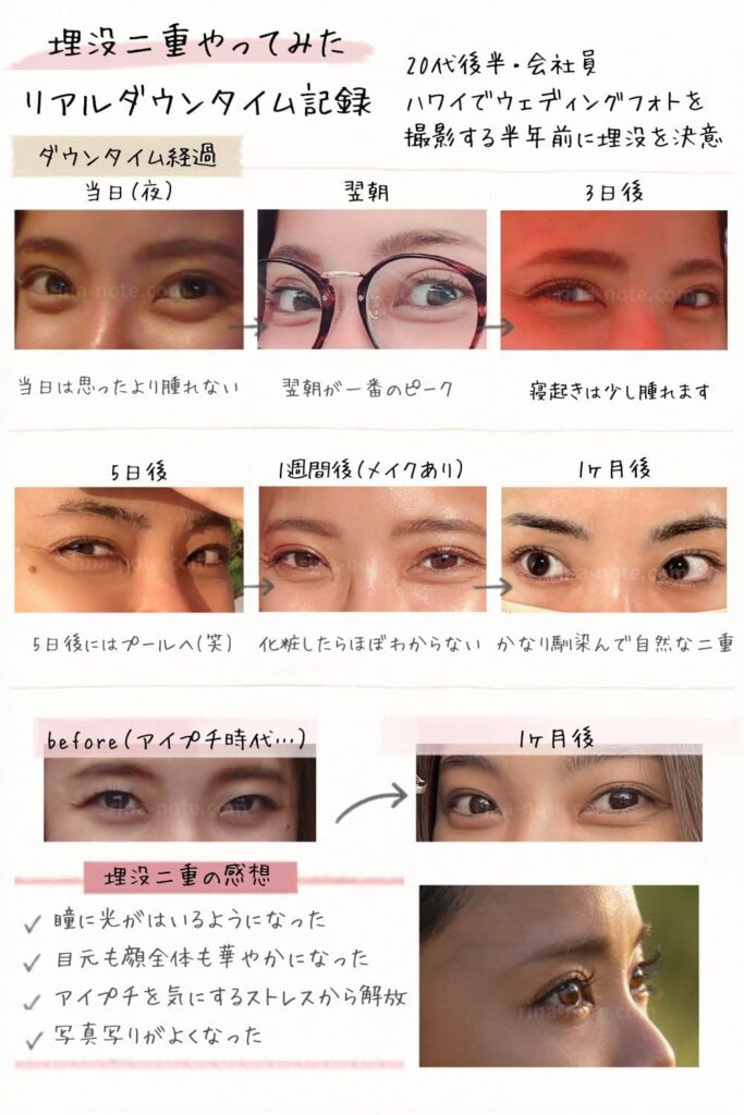 湘南美容外科の埋没ダウンタイム経過写真
