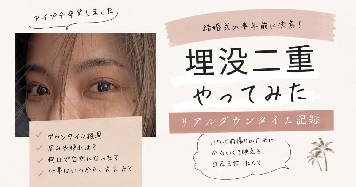 結婚式半年前に湘南美容外科で埋没したリアル体験談