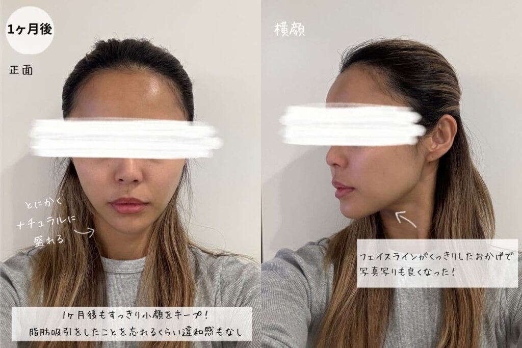 脂肪吸引注射1か月後のフェイスライン