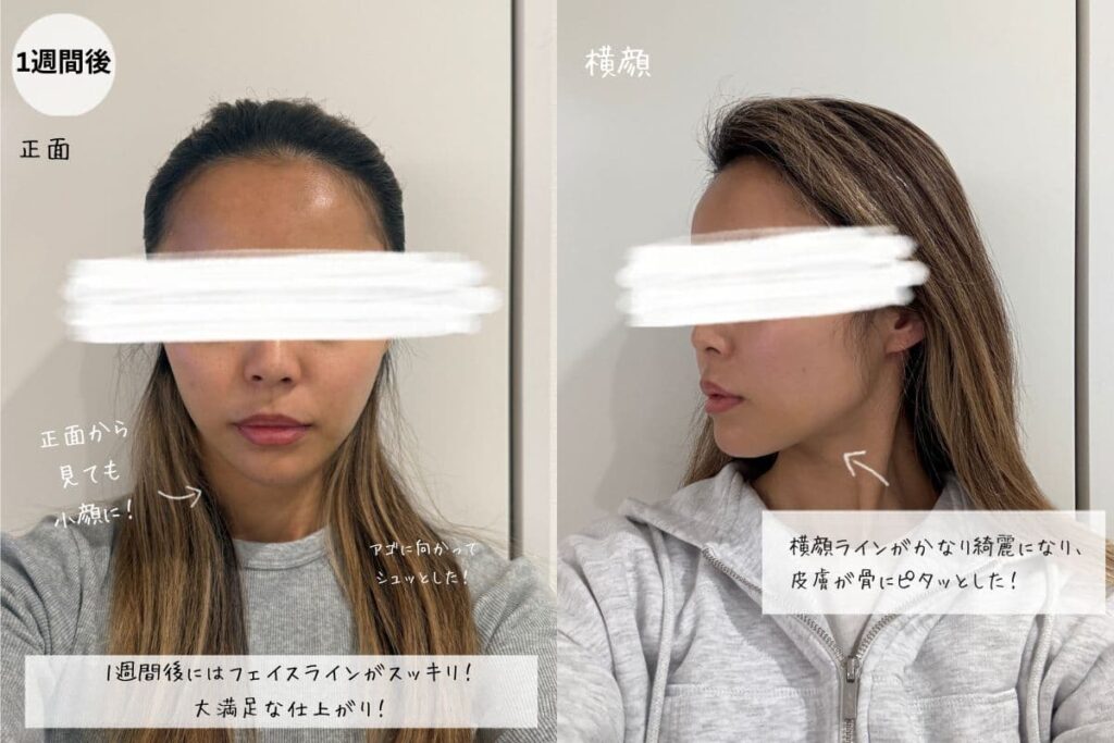 脂肪吸引注射1週間後のフェイスライン