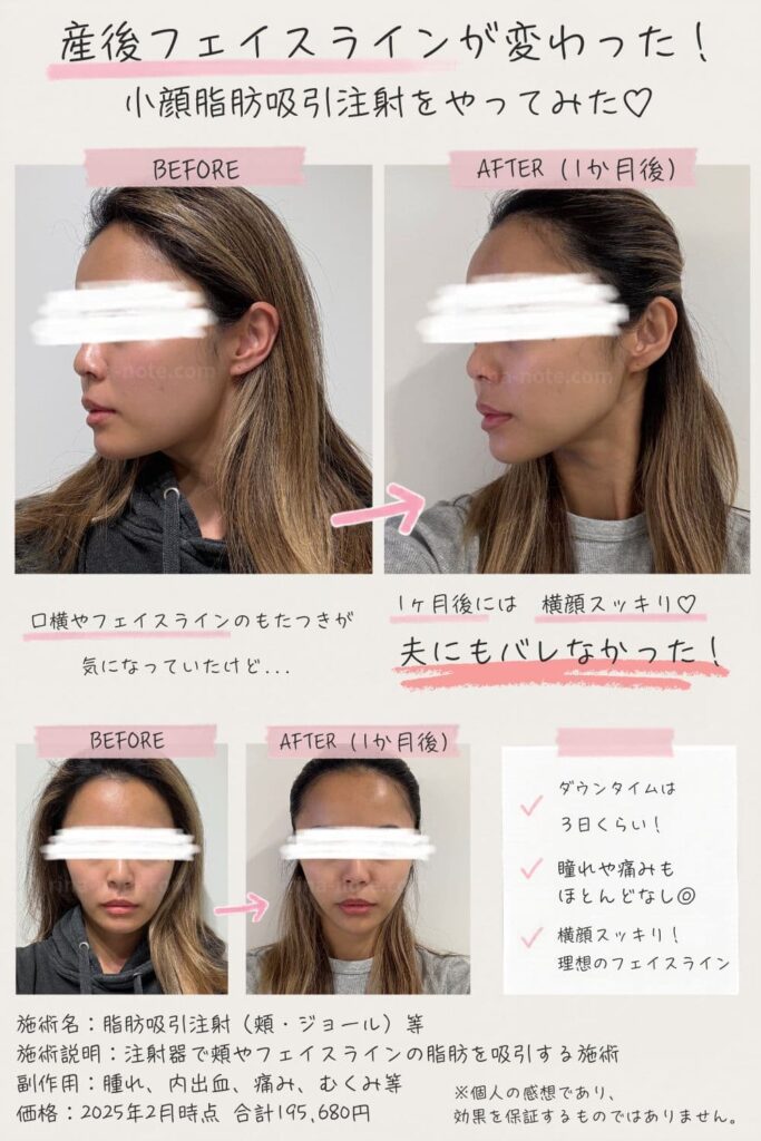 小顔脂肪吸引注射のビフォーアフター比較写真