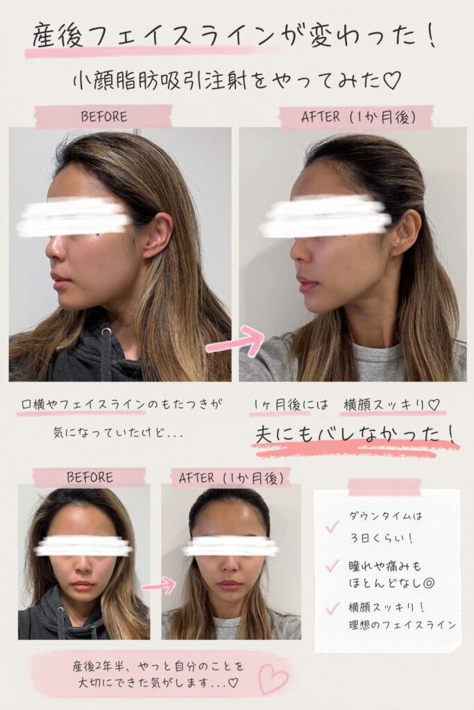 小顔脂肪吸引注射のビフォーアフター比較写真