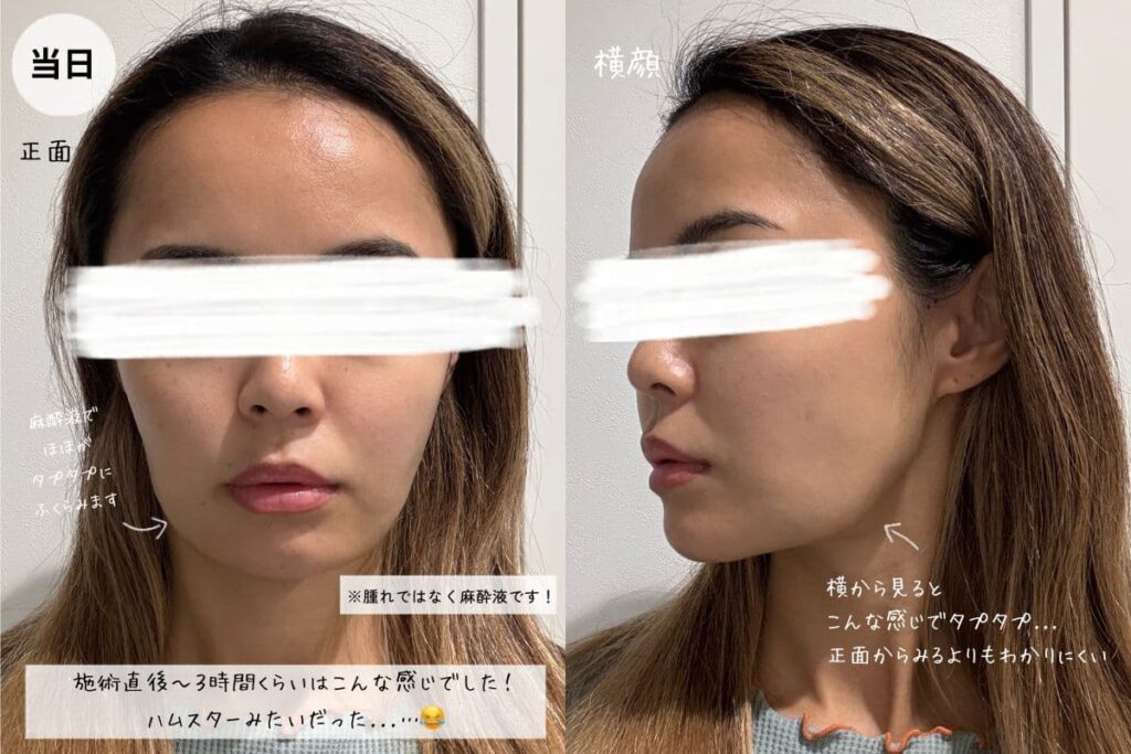 脂肪吸引注射当日のダウンタイムの様子
