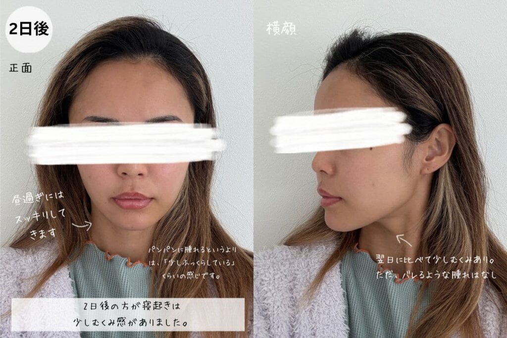 脂肪吸引注射2日後のダウンタイムの様子