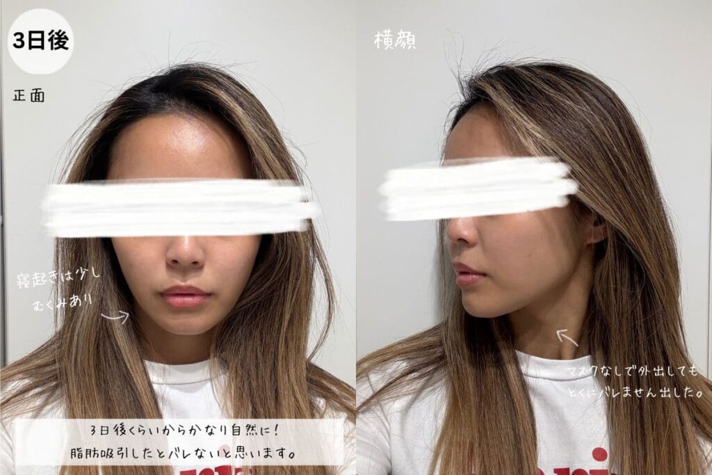 脂肪吸引注射3日後のフェイスライン経過