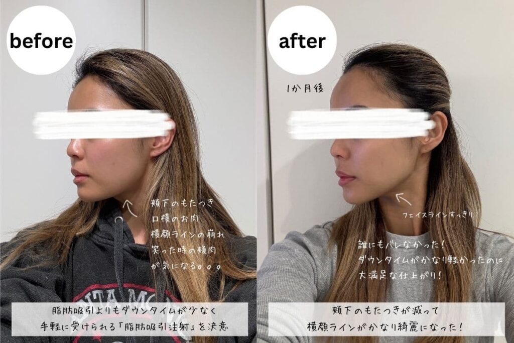脂肪吸引注射1か月後の横顔ビフォーアフター比較