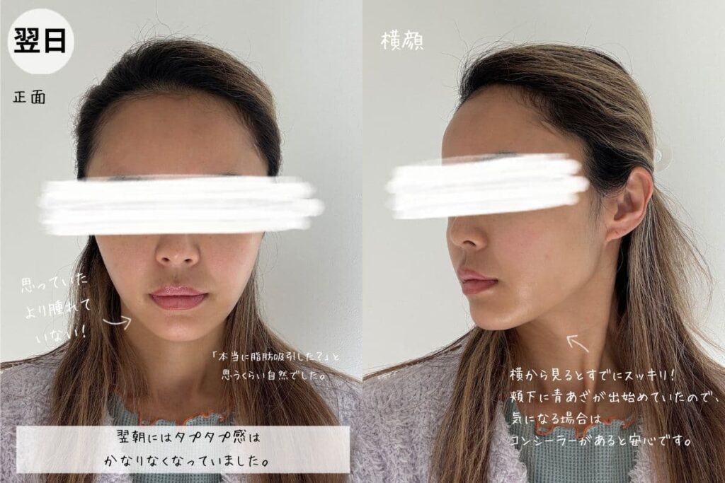 脂肪吸引注射翌日のダウンタイム経過